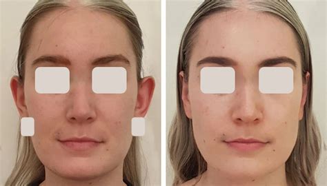 Otoplasty: Procedure, Providers, Photos, Cost .